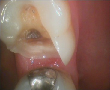 Half-tooth Cutaway